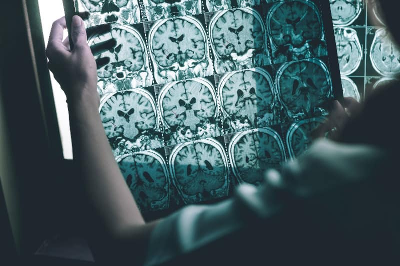 可以透過電腦斷層掃描(CT)、磁力共振(MRI)和正電子掃描(PET)等醫學影像技術來診斷腦退化症。　