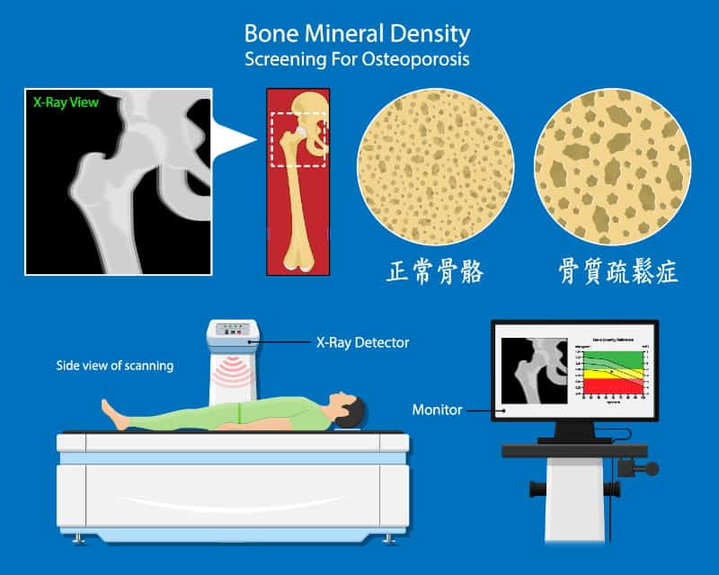 骨質密度﹙BMD﹚檢查是簡要評估骨質健康狀況的快速方法，該檢查可以用來發現骨質疏鬆症。