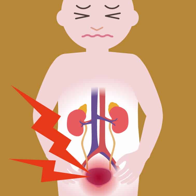 最新研究顯示尿道炎大大增加患上缺血性中風的風險